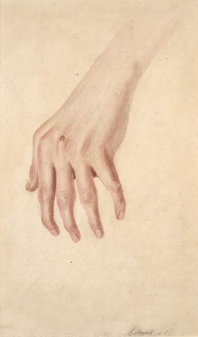 Left hand of a child with rheumatoid arthritis Wellcome