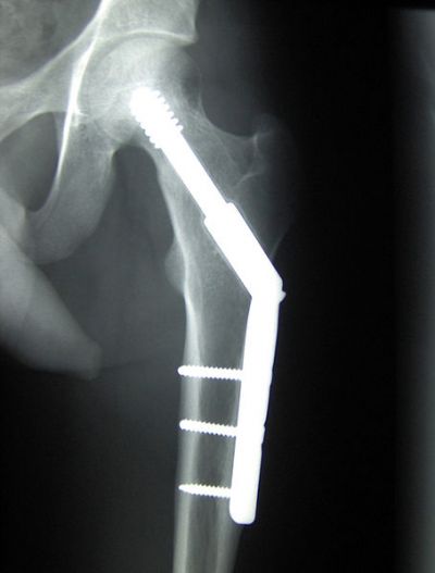 Hip implant, fot. By Booyabazooka [GFDL (httpwww.gnu.orgcopyleftfdl.html) or CC-BY-SA-3.0
