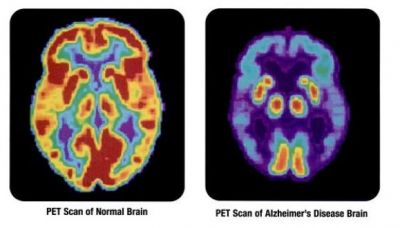 scan normal brain-alzheimers disease brain