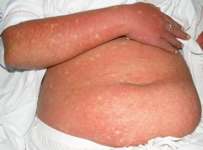 Erythema_with_petechiae_on_patient_with_dengue_fever, fot. By Emy Abi Thomas, Mary John,1 and Bimal Kanish [CC BY 3.0